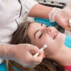 chemical peel